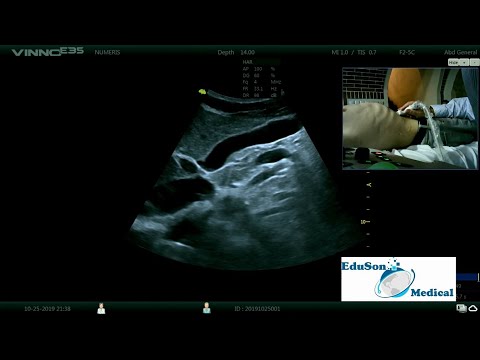 Video: Zobrazovací Modality V Osteoartróze Rukou - Stav A Perspektivy Konvenční Radiografie, Zobrazování Magnetickou Rezonancí A Ultrasonografie