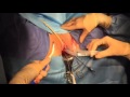 Chirurgie vaginale - Bandelette sous-urétrale