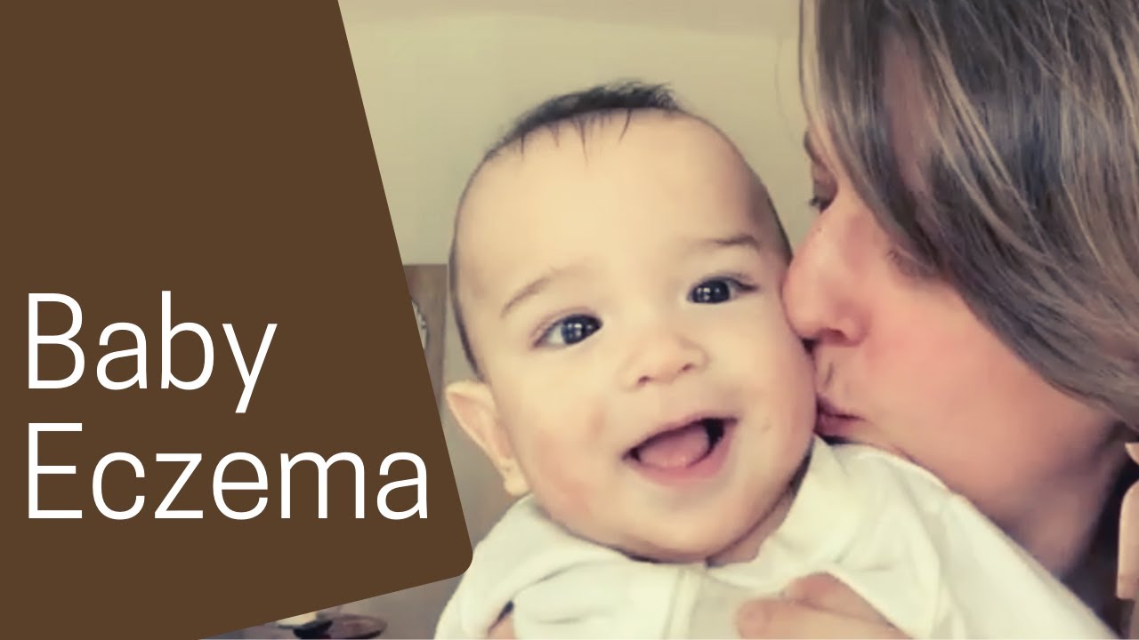 Baby Eczema Treatment Ideas Our Journey So Far... YouTube