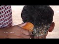 Best Itchy Scalp Dandruff Treatment!! | Big Flakes Scalp Scratching And Picking In Hair #107