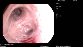 Bronchoscopy/ biopsy/ Бронхоскопия с биопсией