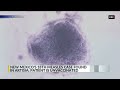 Adult tests positive for measles in Eddy County