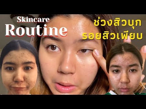 พร เกษม เดอะมอลล์ บางกะปิ New 2022 Skincare พรเกษม ช่วงสิวบุก รอยสิว สิวผด สิวอุดตัน ยำรวมกันอยู่ที่หน้า ใช้เเล้วหน้าใสวัยรุ่นกรี๊ด!