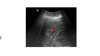 Achados clínicos, ultrassonográficos e tomográficos típicos dos hemangiomas hepáticos