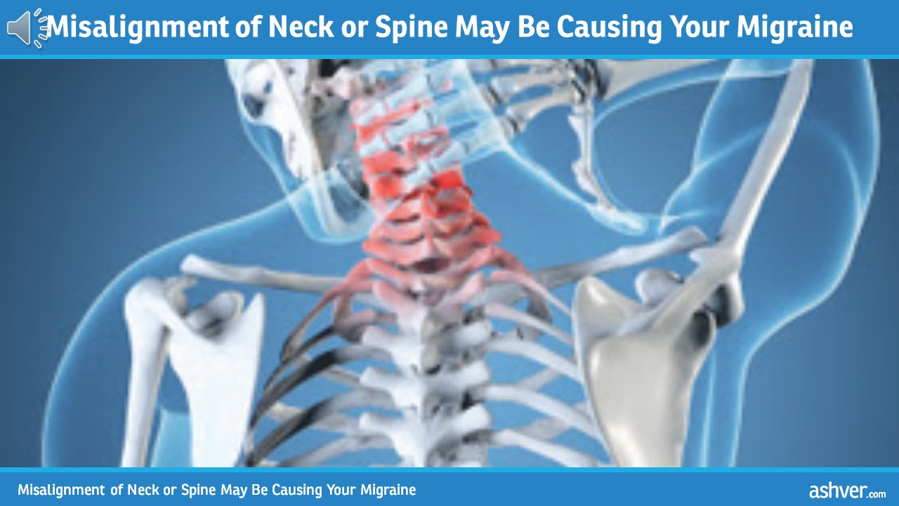 Misalignment of Neck or Spine May Be Causing You Migraine YouTube