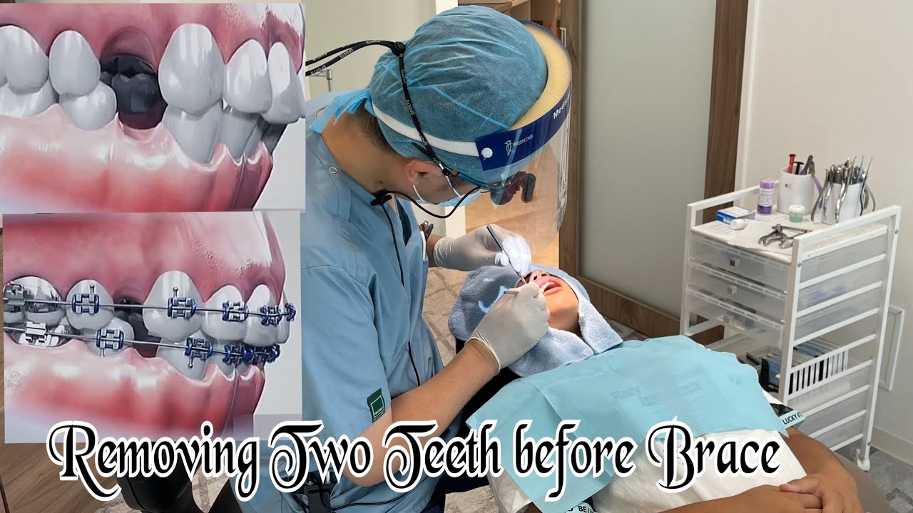 Orthodontic Treatment For Excessive Lip In Japan YouTube