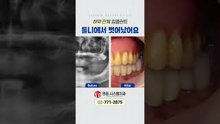 불편한 틀니, 오랜 기간 사용하면 잇몸뼈도 내려않을 수 있습니다! [명동 시스템치과]