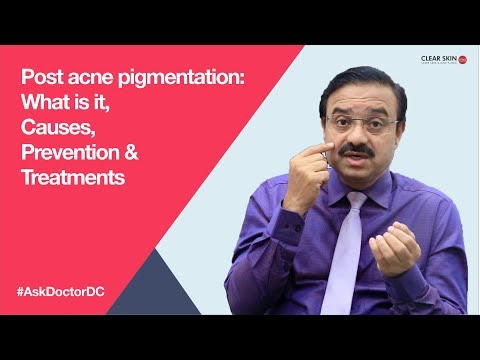 Post acne pigmentation: What is it, Causes, Prevention & Treatments (English)