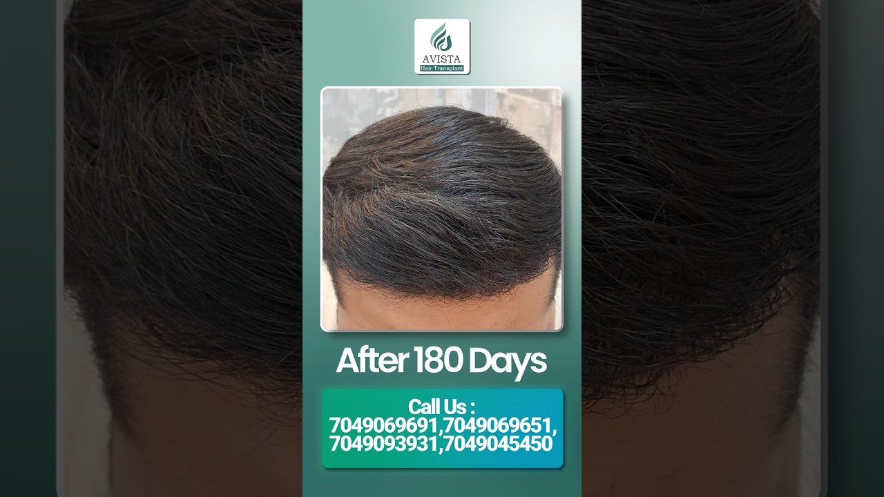 Hair transplant in indore | Amazing Hair transplant result 