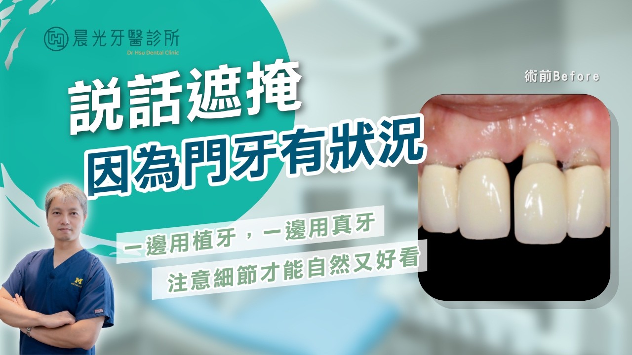 門牙快要掉下來了!|晨光牙醫案例 縮圖