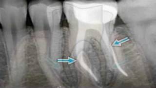 What is Endodontics?
