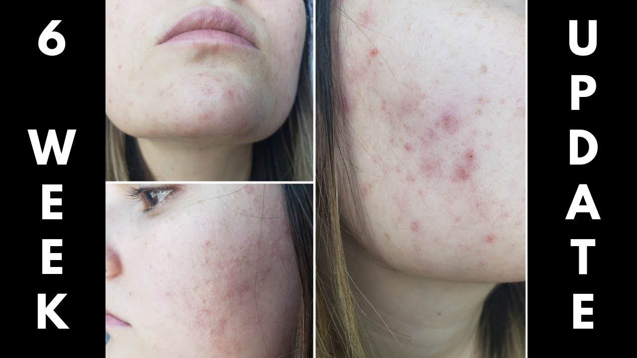 Spironolactone for Acne! 6 WEEK UPDATE! - Episode #4