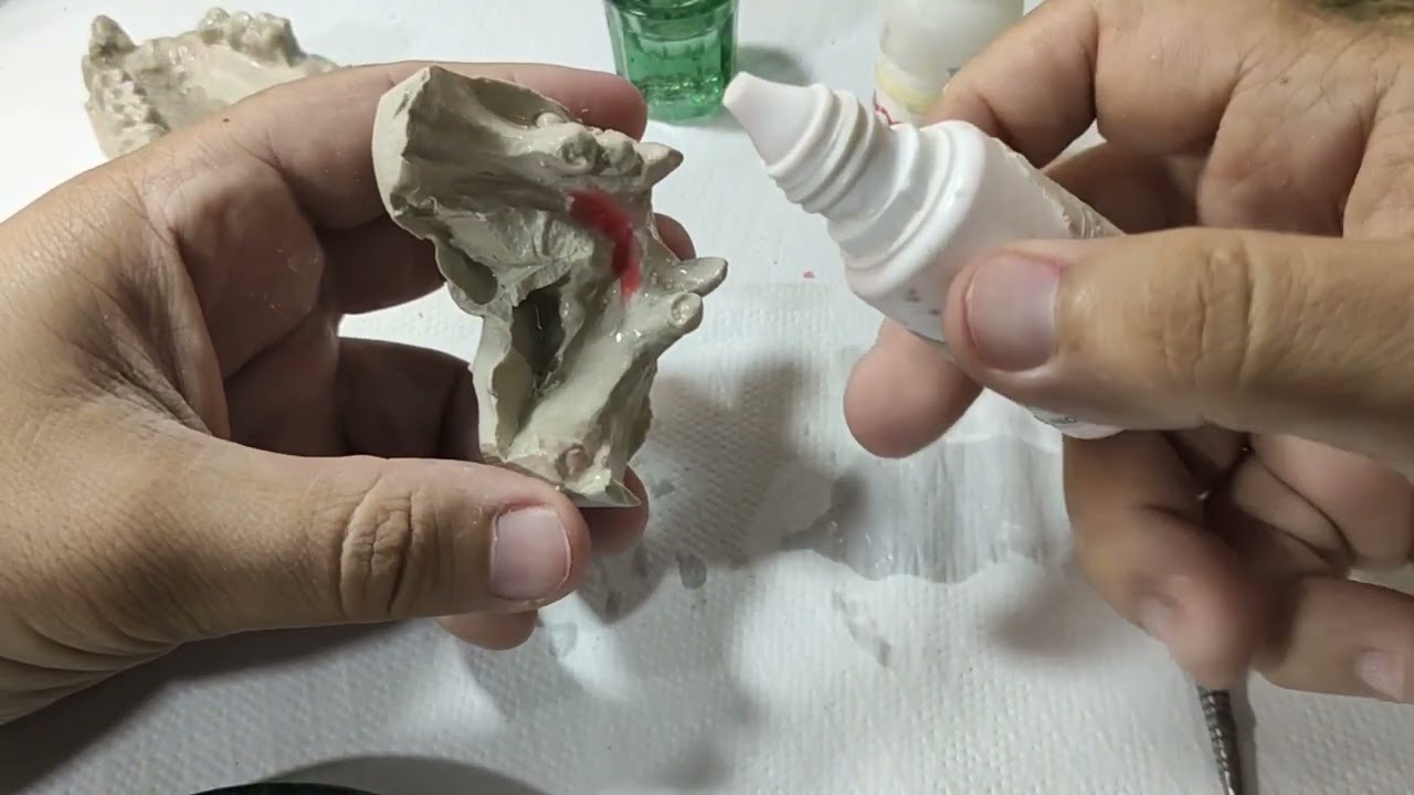 Aula 02 ( Plano de cera ) - curso rápido de prótese flexível.