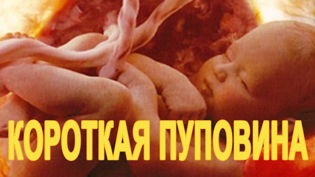 Короткая пуповина при родах. Какие причины и последствия?