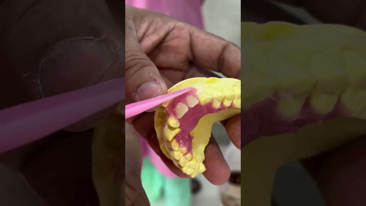 Immediate partial denture/false teeth/temporary denture. This is the procedure to make false teeth 🦷