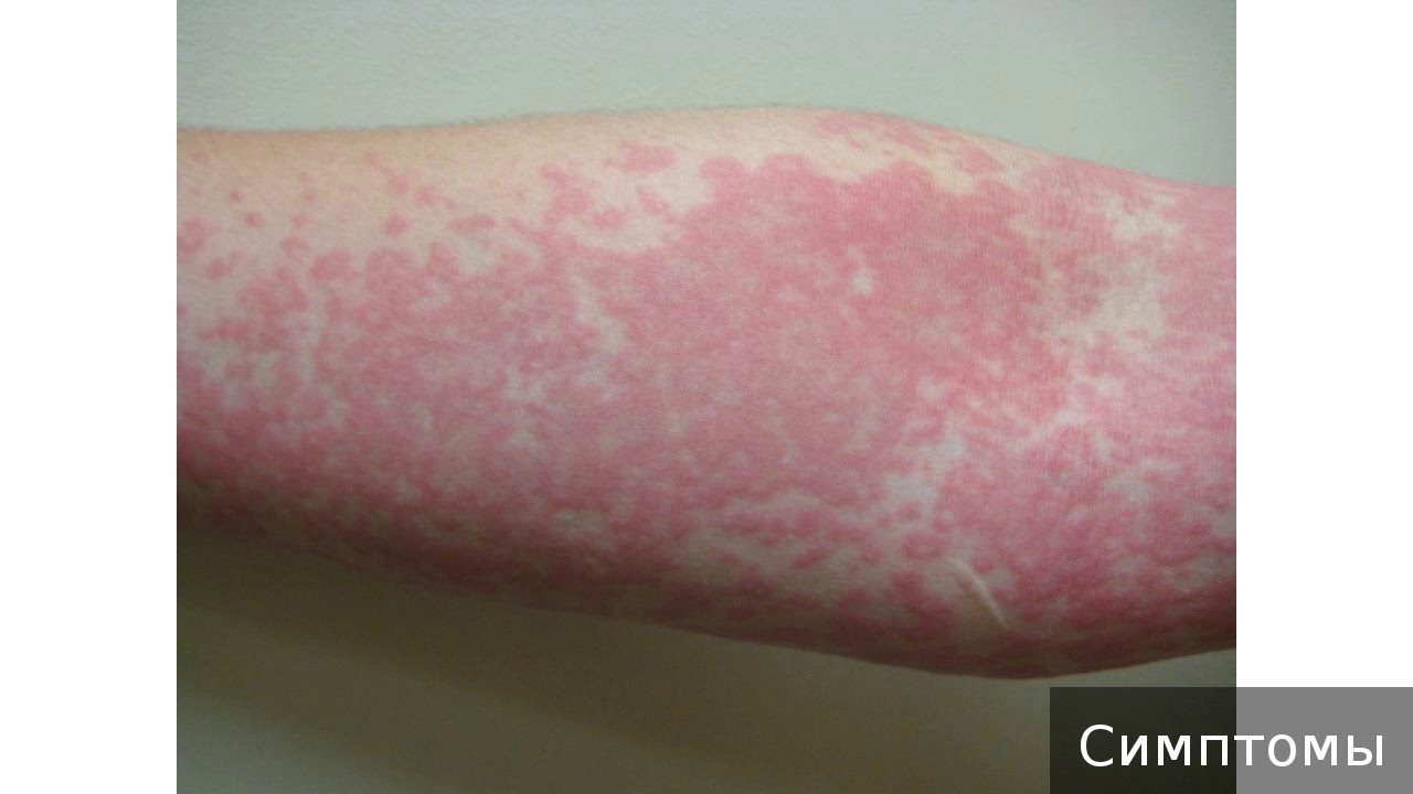 Крапивница. Как лечить крапивницу. - YouTube