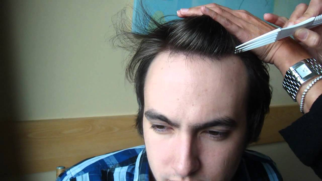 Recreating A Natural Hairline Using Fue Hair Restoration Youtube
