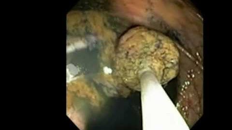 ROTH NET™ Platinum™ Retriever: polyp retrieval