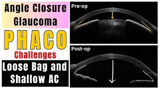 Phaco- Lens Extraction In Angle Closure Glaucoma - Tough Case Weak Zonules Capsule Hooks Ctr