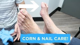 Apical Heloma Durum Treatment | Corn and Nail Care