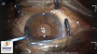 Small pupil PXF Dr Sourabh Patwardhan Cataract surgery.call 9220001000