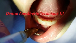 DENTAL ANESTHESIA TECHNIQUE - EXPLAINED !!!