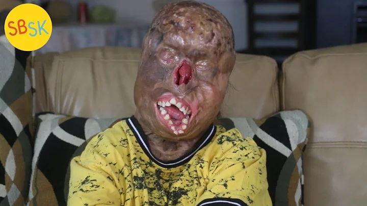 Surviving Severe Burns (Doctors Say Hes a Miracle)