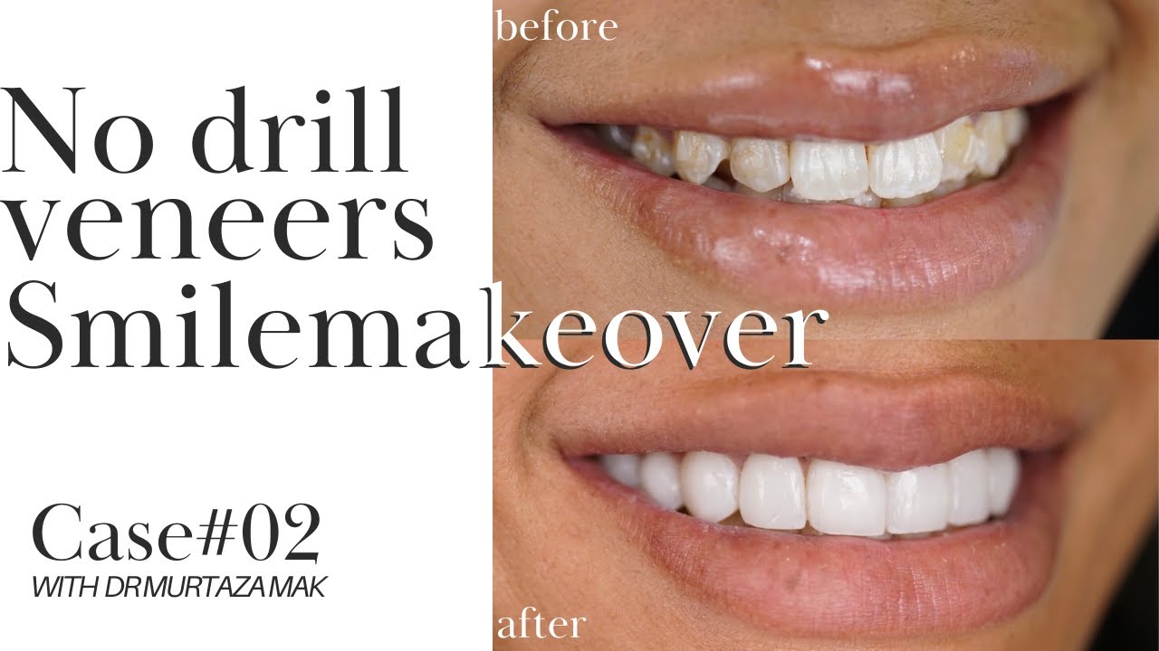 No Drill Veneers Smilemakeover Case 02 with DR MURTAZA MAK YouTube