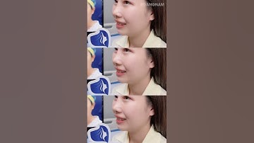 Nâng Mũi Cấu Trúc 3D - Hút Mọi Ánh Nhìn Với Dáng Mũi Cao Chuẩn Tỷ Lệ Vàng