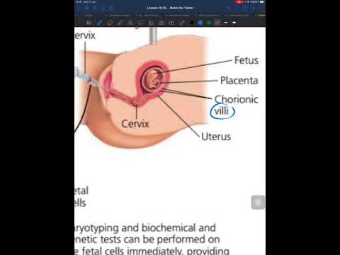 Amniocentesis and Chorionic villus sampling Video