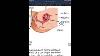 Amniocentesis and Chorionic villus sampling Video