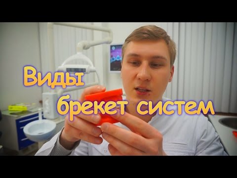 Виды брекет систем