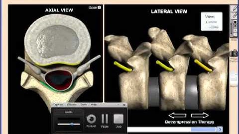 Spinal Decompression Therapy Video