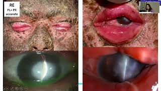 Aiocmtc4 2025 - Gp45 - Just Cases - Corneal Infections, Keratoconus Keratoplasty