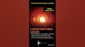 Bionic Eye Implant Restores Vision for Macular Degeneration Patients