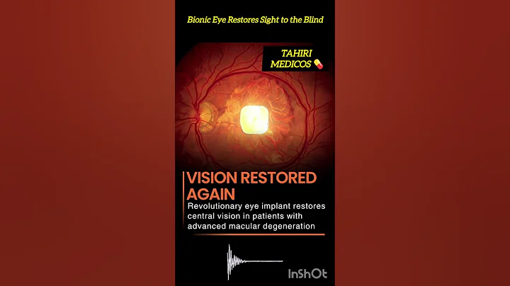 Bionic Eye Implant Restores Vision for Macular Degeneration Patients
