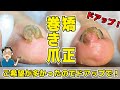 長年まいていた巻き爪がみるみる【相模原・町田巻き爪矯正センター】