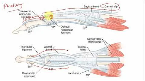 Why swan neck deformity in Rheumatoid arthritis?