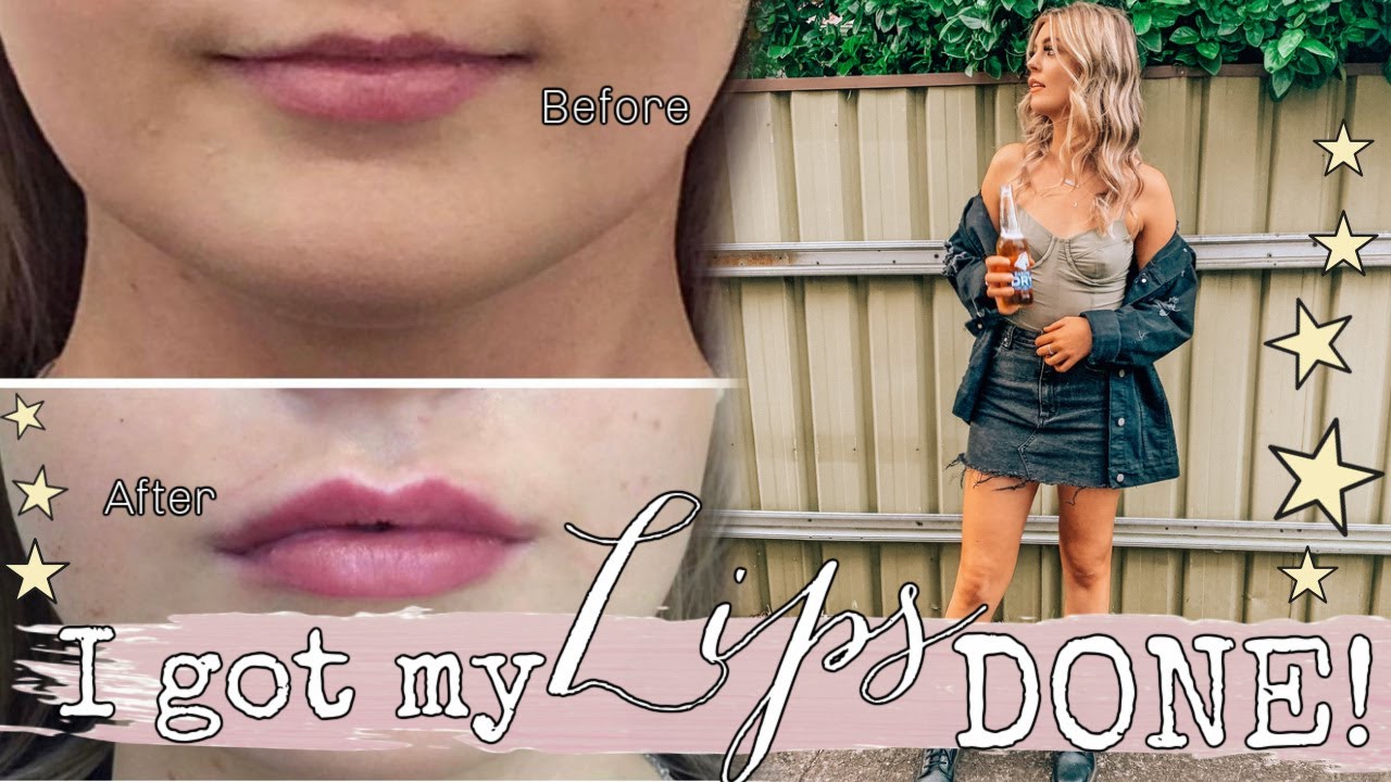NATURAL Lip Injections! | My FULL Experience || Lacey Jane