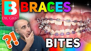 Braces Overbite, Overjet, Underbite, Crossbite &amp; Open Bite Explained!