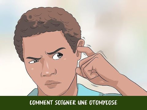 Vidéo: L'otomycose peut-elle entraîner une perte auditive ?