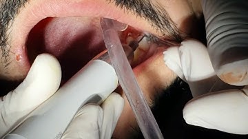Surgical extraction of 3rd molar with Piezosurgery