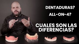 Dentaduras vs Sobre Dentaduras vs Allon4 Implantes Dentales