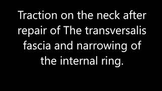 A test for internal ring competency in open inguinal hernia repair.