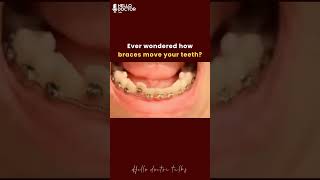 Ever wondered how braces move your teeth? #healthchannel #doctorslife #dentalartistry #dentist