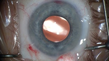 Managing challenges of  iTrack™ canaloplasty: Obstruction in Schlemm