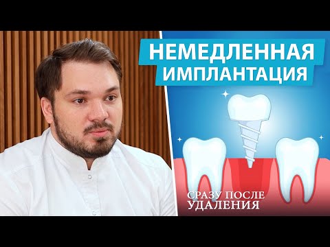 Можно ли ставить имплант сразу после удаления зуба? Одномоментная имплантация за 1 день!