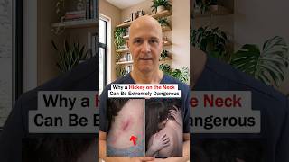 Can a Hickey Actually Cause a Stroke? (The Hidden Danger) #HickeyDanger​#MedicalFacts​