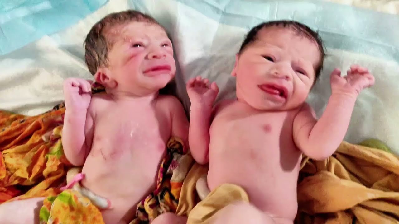Twins Newborn babies with forceps delivery Blessed Long Awaited Parents with their First cry 