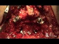Pedicle Substraction Osteotomy Demonstration by Christopher Shaffery, M.D.